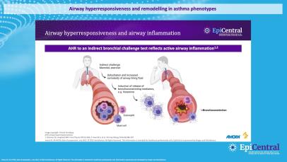 Airway hyperresponsiveness and remodelling in asthma phenotypes (4/4) 